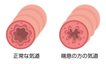 気管支喘息