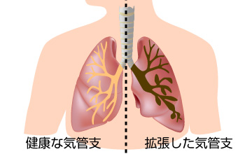 気管支拡張症