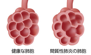 間質性肺炎